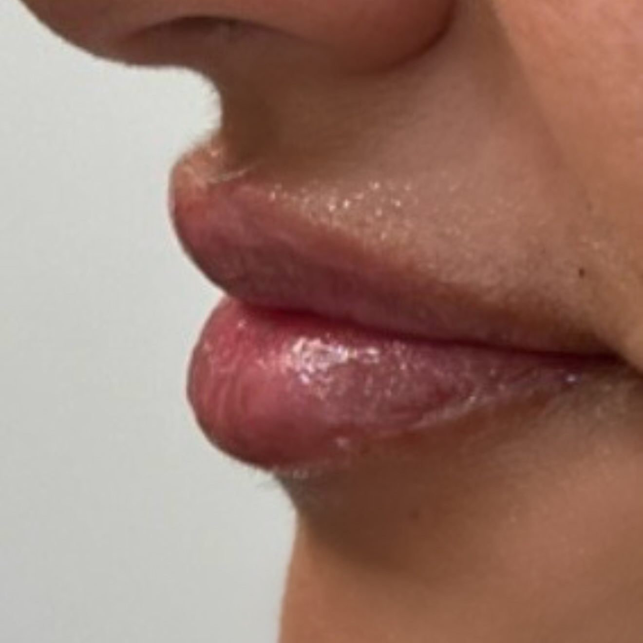 Dermal Fillers / Lip Filler
